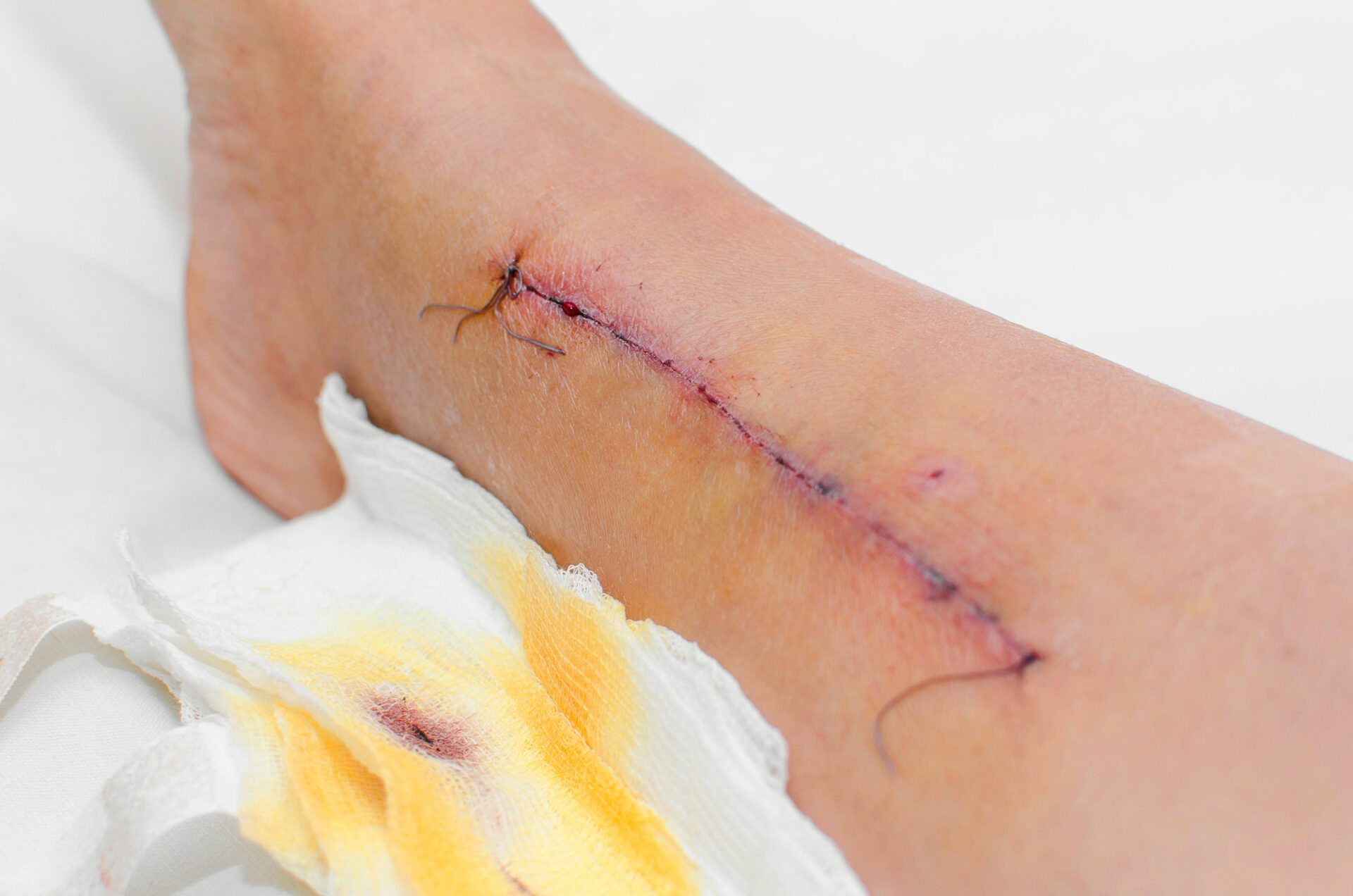 Medical suture on the leg
